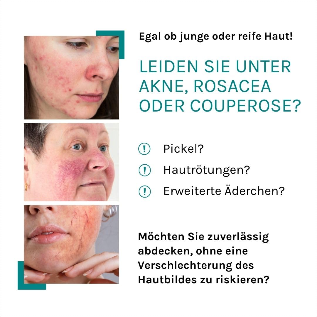 Benevi Pigment Cream 20 ml zum gezielten Abdecken von Rötungen, Pickeln, Unreinheiten oder als Make-up-Ersatz. Kaschiert zuverlässig erweiterte und rote Äderchen bei Couperose und Rosacea (leicht) – Bild 2